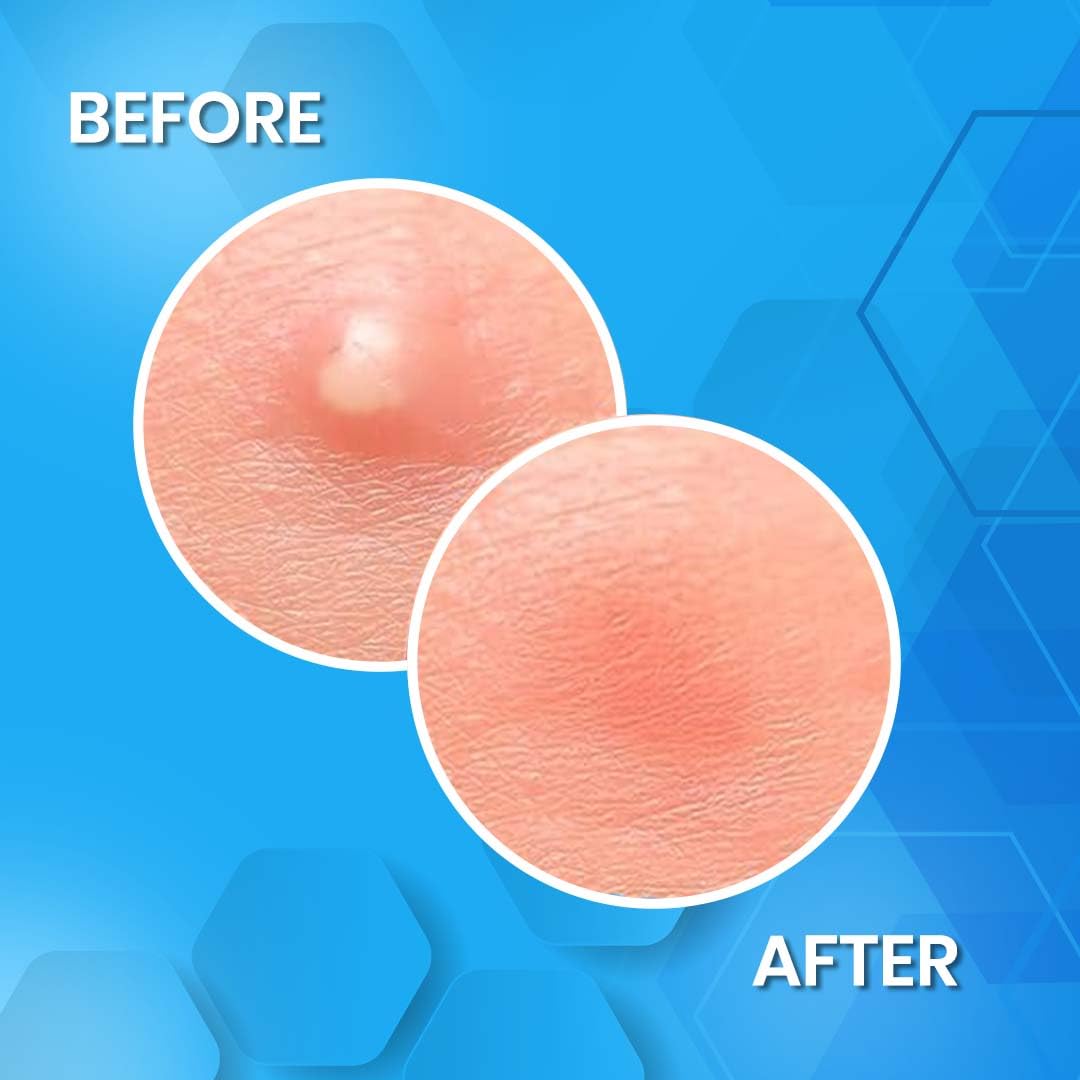 Bio Mystery Hydrocolloid Acne Patch – Invisible Pimple Patches for Face, Overnight Spot Treatment, 2 Sizes